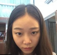 廣州美萊羅延平醫(yī)生隆鼻果怎么樣？真人案例圖拿去借鑒！