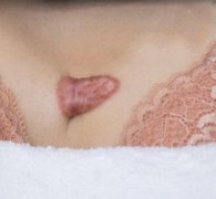 寧夏醫(yī)學(xué)院附屬醫(yī)院整形美容去疤痕怎么樣？果圖一覽