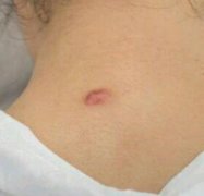 濟(jì)南市第四人民醫(yī)院美容科去疤痕怎么樣？果圖一覽