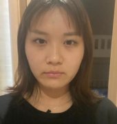 做完眼部綜合手術(shù)后果滿意，想要記錄一下自己變美的歷程