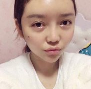 石家莊妹子做了自體脂肪面部填充術(shù)后兩個(gè)月對比圖_冀美整形案例一覽