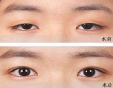 眼瞼下垂的種類有哪些？矯正方法及注意事項分享