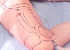 腿部抽脂多久可以恢復(fù)？術(shù)后注意事項(xiàng)有哪些？