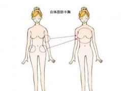自體脂肪豐胸多少錢(qián)？這三個(gè)因素是造成價(jià)格差異的原因
