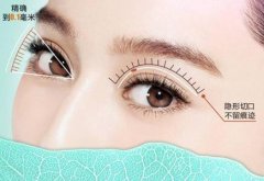 做吸雕雙眼皮要注意些什么？此手術不適合的人群有哪些？