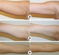 手臂抽脂有什么風(fēng)險和后遺癥？