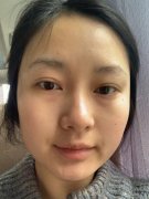 蘇州市立醫(yī)院做面部吸脂多少錢？附脂肪整形真實(shí)案例果分享