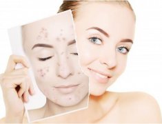 激光去痘印怎么樣