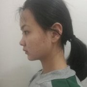 上海市第六人民醫(yī)院整形好不好？做隆鼻案例真實(shí)果反饋