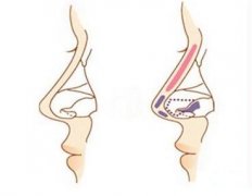 假體隆鼻取出后鼻子會(huì)更塌嗎