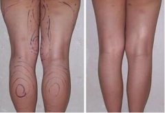 抽脂腿部多久恢復(fù)