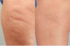 吸脂后凹凸不平是長(zhǎng)期的么