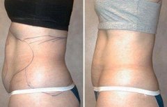 肚子抽脂有什么風(fēng)險(xiǎn)和后遺癥