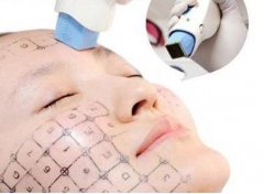 熱瑪吉一次多少錢?原理是什么?