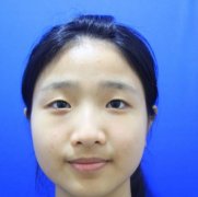 常冬青修復(fù)雙眼皮怎么樣？技術(shù)好不好，先來看看案例在評價(jià)~