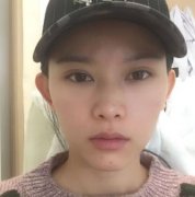 杭州同榮麗格隆鼻案例怎么樣？分享術(shù)前術(shù)后果圖_恢復(fù)過程心得