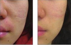 傳統(tǒng)磨削方法有哪些?和微晶磨削有什么區(qū)別?