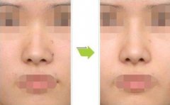 在成都做歪鼻子矯正要多少錢?疼嗎?果怎樣?