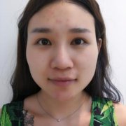 北京圣嘉榮是三甲醫(yī)院?jiǎn)?？磨骨案例及價(jià)格表在線預(yù)看