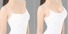 隆胸后有多痛呢?術(shù)后護(hù)理事項(xiàng)必須要做好