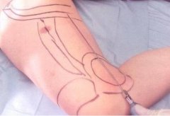 小腿抽脂的價格是多少?大腿抽脂有哪些注意事項?