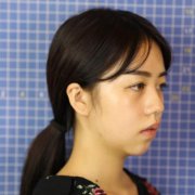 四川人民醫(yī)院東籬醫(yī)院怎么樣？看專家鼻部手術案例~反饋恢復果圖