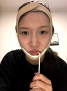 上海九院沈國芳正頜手術(shù)案例果圖_項目價格表_醫(yī)生口碑詳情