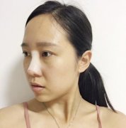 西安醫(yī)學(xué)院第二附屬醫(yī)院整形科隆鼻修復(fù)案例和價(jià)格費(fèi)用更新上線～