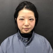 西京醫(yī)院整形科做眼睛修復(fù)靠譜嗎？說說我的經(jīng)歷并恢復(fù)果圖附上