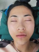 八大處玻尿酸墊下巴的價格是多少？2021新案例果圖全覽~