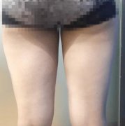 北醫(yī)三院整形科吸脂案例~術后90天較終果圖分享