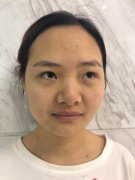 廣州紫馨美容醫(yī)院做鼻子怎么樣? 案例詳細過程分享~看我3個月果咋樣！