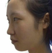 邯鄲三院雙眼皮價(jià)格費(fèi)用多少？真人術(shù)后恢復(fù)日記公開一覽