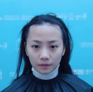 八大處整形醫(yī)院植發(fā)怎么樣？案例果圖給你真實參考