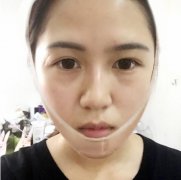 寧波市第六醫(yī)院整復外科面部吸脂果反饋~恢復果圖90天展示