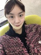 華西醫(yī)院整形美容燒傷科價目表！含2021新面部吸脂案例恢復(fù)記錄反饋