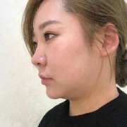 山東省立醫(yī)院整形美容外科注射瘦臉怎么樣？看看案例果圖對比