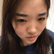 重慶三峽醫(yī)院整形外科水光補(bǔ)水怎么樣？看看案例果圖對(duì)比