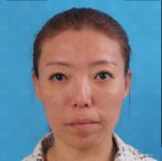 北京301醫(yī)院脂肪填充怎么樣？來(lái)對(duì)比面部脂肪填充案例和價(jià)格收費(fèi)