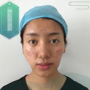 廣州南方醫(yī)院脂肪填充怎么樣？面部脂肪填充案例恢復(fù)照片和價格分享