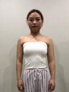 南寧市第一人民醫(yī)院整形美容科腰腹吸脂案例圖~分享我的90天恢復(fù)經(jīng)歷