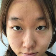 聊城人民醫(yī)院做的雙眼皮怎么樣?術(shù)后恢復(fù)情況對比圖分享