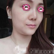 佛山市第一人民醫(yī)院整形美容科注射瘦臉案例~90天真人實拍圖 