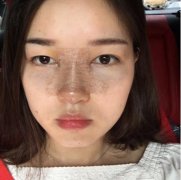 西安美立方做鼻子怎么樣？看看隆鼻整形案例+果圖分享!