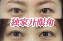 廣州開眼角哪個醫(yī)院好？匯總前五現(xiàn)已發(fā)布！附眼部整形價格查詢