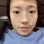 寧波薇琳張廣巍修復(fù)鼻子好嗎？2021案例和價格表詳情分享