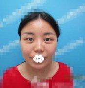 成都中醫(yī)大銀海眼科醫(yī)院全切雙眼皮案例分享！手術恢復過程真實記錄