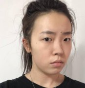 上海美聯(lián)臣整形醫(yī)院鼻部手術案例果公布！含價格費用整理