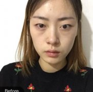 深圳富華醫(yī)療美容醫(yī)院眼部手術(shù)果咋樣!對比看案例果及價格價位明細(xì)