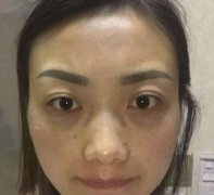 北醫(yī)三院整形科去眼袋怎么樣？手術前后對比圖真實記錄